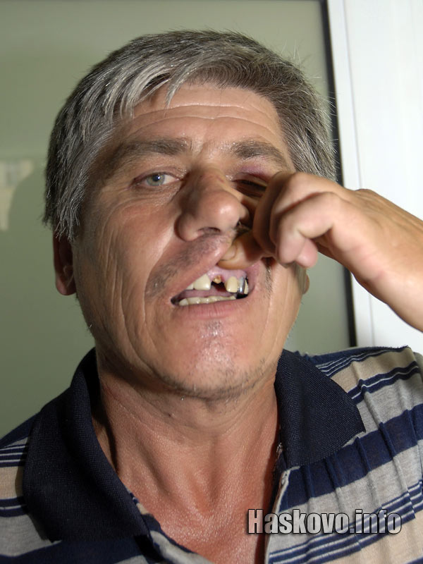 Битият кмет остана без зъб