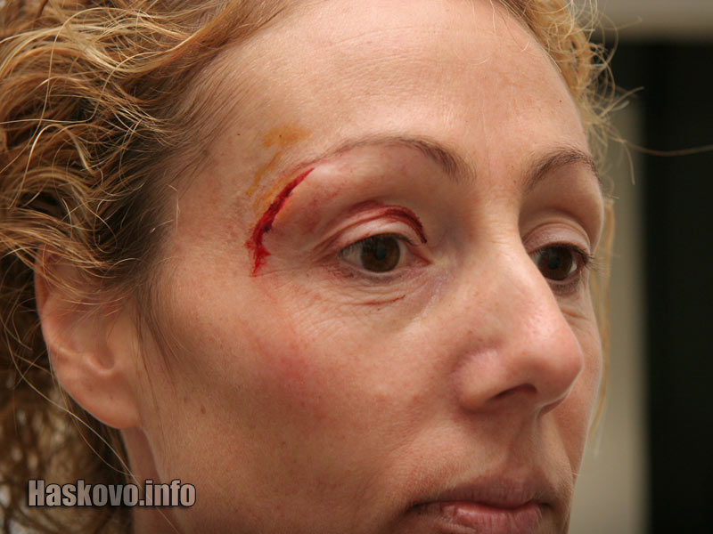 Разцепената вежда