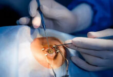 Очна хирургия